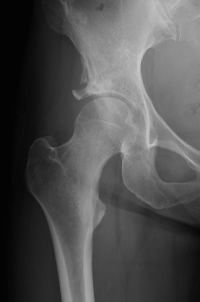 acetabular-dysplasia-01