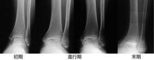 ankle_joint