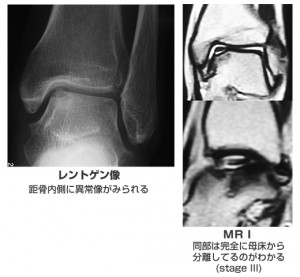 cartilage_disorder_2