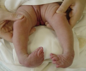clubfeet_1