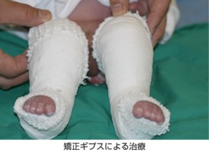 clubfeet_2