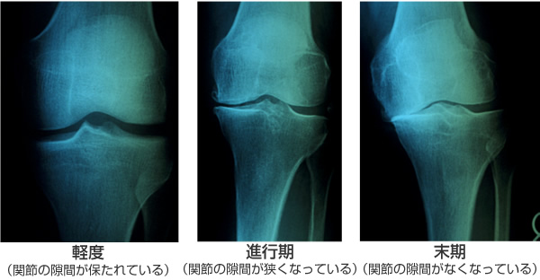 ganorthrosis_1