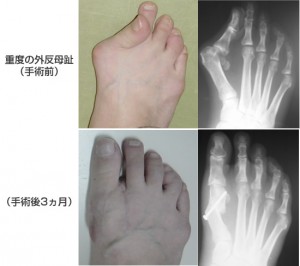 hallux_valgus_1