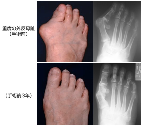 hallux_valgus_2