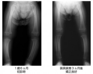 infant_bowlegs_1