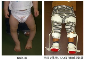 infant_bowlegs_2