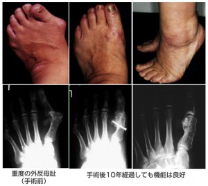 外反母趾手術写真